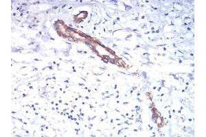 Immunohistochemical analysis of paraffin-embedded liver cancer tissues using TSHB mouse mAb with DAB staining. (TSHB antibody  (AA 20-139))
