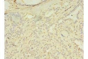 Immunohistochemistry of paraffin-embedded human breast cancer using ABIN7172654 at dilution of 1:100 (SPIC antibody  (AA 1-248))