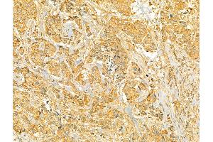 ABIN6265998 and ABIN6273087 at 1/100 staining Human breast cancer by IHC-P. (VPS37A antibody  (N-Term))