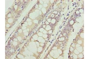 Immunohistochemistry of paraffin-embedded human colon cancer using ABIN7175315 at dilution of 1:100 (VPS45 antibody  (AA 101-400))