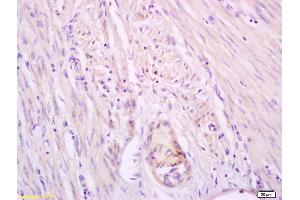 Formalin-fixed and paraffin embedded human breast carcinoma labeled with Anti-Phospho-Beta-Catenin(Ser33/37) Polyclonal Antibody, Unconjugated (ABIN683893) at 1:200 followed by conjugation to the secondary antibody and DAB staining (beta Catenin antibody  (pSer33, pSer37))