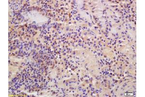 Formalin-fixed and paraffin embedded human gastric carcinoma labeled with Anti-MTF-1 Polyclonal Antibody, Unconjugated (ABIN701425) at 1:200 followed by conjugation to the secondary antibody and DAB staining