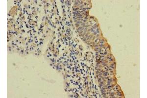 Immunohistochemistry of paraffin-embedded human bladder cancer using ABIN7169984 at dilution of 1:100 (SLC6A15 antibody  (AA 357-452))