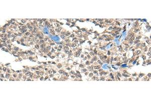 Immunohistochemistry of paraffin-embedded Human ovarian cancer tissue using REST Polyclonal Antibody at dilution of 1:50(x200) (REST antibody)