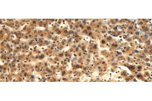 Immunohistochemistry of paraffin-embedded Human liver cancer tissue using TMOD1 Polyclonal Antibody at dilution of 1:60(x200) (Tropomodulin 1 antibody)