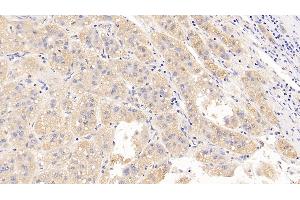 Detection of LH in Human Liver cancer Tissue using Polyclonal Antibody to Luteinizing Hormone (LH) (Luteinizing Hormone antibody)