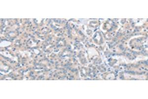 Immunohistochemistry of paraffin-embedded Human thyroid cancer tissue using SLC17A6 Polyclonal Antibody at dilution of 1:100(x200) (Solute Carrier Family 17 (Vesicular Glutamate Transporter), Member 6 (SLC17A6) antibody)