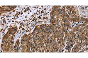 Immunohistochemistry of paraffin-embedded Human lung cancer tissue using PLXNB1 Polyclonal Antibody at dilution 1:40