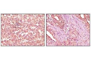 Immunohistochemical analysis of paraffin-embedded human skin carcinoma (left) and pancreas carcinoma (right) tissue, showing cytoplasmic localization using EphA2 antibody with DAB staining. (EPH Receptor A2 antibody)
