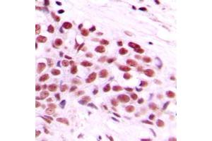 Immunohistochemical analysis of c-Myc (pT58) staining in human breast cancer formalin fixed paraffin embedded tissue section.