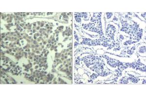 Immunohistochemical analysis of paraffin-embedded human breast carcinoma tissue using c-kit (phospho-Tyr936) Antibody (E011539). (KIT antibody  (pTyr936))