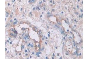 Detection of IL33 in Human Glioma Tissue using Monoclonal Antibody to Interleukin 33 (IL33) (IL-33 antibody  (AA 112-270))