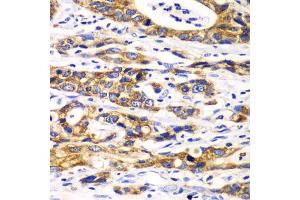 Immunohistochemistry of paraffin-embedded human gastric cancer using RPN1 antibody. (RPN1 antibody)