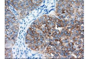 Immunohistochemical staining of paraffin-embedded Adenocarcinoma of Human colon tissue using anti-IGF2BP2 mouse monoclonal antibody. (IGF2BP2 antibody)