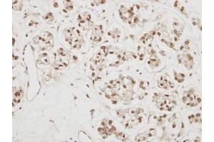 IHC-P Image Immunohistochemical analysis of paraffin-embedded OVCA xenograft, using NCBP1, antibody at 1:500 dilution. (NCBP1 antibody  (N-Term))