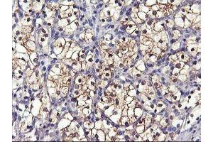 Immunohistochemical staining of paraffin-embedded Carcinoma of Human kidney tissue using anti-GSTO2 mouse monoclonal antibody. (GSTO2 antibody)