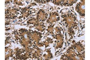 The image on the left is immunohistochemistry of paraffin-embedded Human colon cancer tissue using ABIN7191755(P2RY1 Antibody) at dilution 1/40, on the right is treated with synthetic peptide. (P2RY1 antibody)