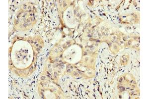 IHC image of ABIN7162986 diluted at 1:200 and staining in paraffin-embedded human cervical cancer performed on a Leica BondTM system. (PEX5 antibody  (AA 149-283))