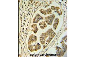 HCCS Antibody IHC analysis in formalin fixed and paraffin embedded colon carcinoma followed by peroxidase conjugation of the secondary antibody and DAB staining. (HCCS antibody  (AA 173-200))