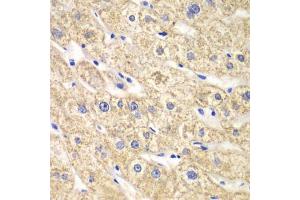 Immunohistochemistry of paraffin-embedded human liver injury using ACADS antibody (ABIN5970342) at dilution of 1/100 (40x lens). (ACADS antibody)