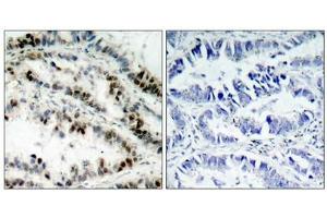 Immunohistochemical analysis of paraffin-embedded human lung carcinoma tissue using SMC1(Phospho-Ser957) Antibody(left) or the same antibody preincubated with blocking peptide(right). (SMC1A antibody  (pSer957))