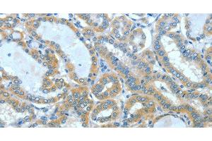 Immunohistochemistry of paraffin-embedded Human thyroid cancer using SPHK2 Polyclonal Antibody at dilution of 1:60 (SPHK2 antibody)