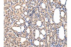 The image on the left is immunohistochemistry of paraffin-embedded Human thyroid cancer tissue using ABIN7127988(PPIL1 Antibody) at dilution 1/30, on the right is treated with fusion protein. (PPIL1 antibody)