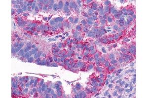 Anti-NTSR2 / NTR2 antibody IHC of human Ovary, Carcinoma. (NTSR2 antibody  (C-Term))