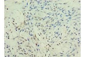 Immunohistochemistry of paraffin-embedded human breast cancer using ABIN7157755 at dilution of 1:100 (KMO antibody  (AA 1-260))