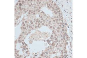 Immunohistochemistry of paraffin-embedded human breast cancer using ZNF703 antibody (ABIN7271524) at dilution of 1:100 (40x lens). (ZNF703 antibody  (AA 160-290))