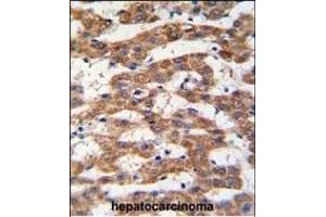 Formalin-fixed and paraffin-embedded human hepatocarcinoma tissue reacted with PHB antibody (Center) (ABIN389162 and ABIN2839329) , which was peroxidase-conjugated to the secondary antibody, followed by DAB staining.