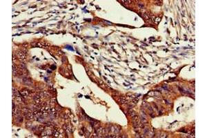 Immunohistochemistry of paraffin-embedded human colon cancer using ABIN7176539 at dilution of 1:100 (Zinc Finger Protein 816A (ZNF816A) (AA 1-200) antibody)