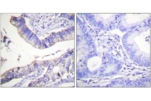 Immunohistochemistry analysis of paraffin-embedded human colon carcinoma tissue, using BCL-2 (Ab-69) Antibody.
