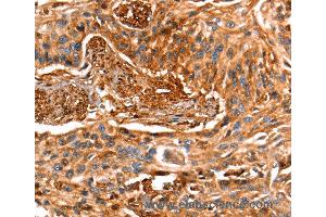 Immunohistochemistry of Human esophagus cancer using LGALS1 Polyclonal Antibody at dilution of 1:25 (LGALS1/Galectin 1 antibody)