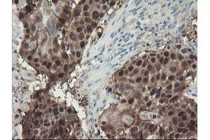 Immunohistochemical staining of paraffin-embedded Carcinoma of Human lung tissue using anti-ADH7 mouse monoclonal antibody. (ADH7 antibody)