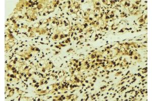ABIN6276713 at 1/100 staining Human breast cancer tissue by IHC-P.