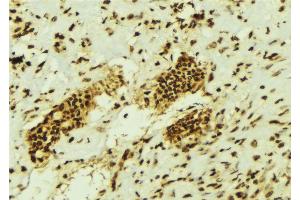 ABIN6274457 at 1/100 staining Human breast cancer tissue by IHC-P. (EZH1 antibody  (Internal Region))
