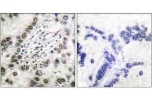 Immunohistochemistry analysis of paraffin-embedded human lung carcinoma tissue, using CBP (Ab-1535) Antibody.