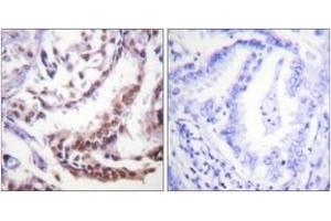 Immunohistochemistry analysis of paraffin-embedded human lung carcinoma tissue, using Histone H3 (Acetyl-Lys9) Antibody. (Histone 3 antibody  (H3K9ac))