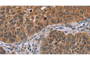 Immunohistochemistry of paraffin-embedded Human lung cancer tissue using IHH Polyclonal Antibody at dilution 1:30 (Indian Hedgehog antibody)