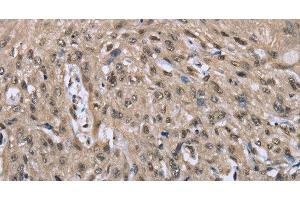 Immunohistochemistry of paraffin-embedded Human esophagus cancer tissue using DYNLL1 Polyclonal Antibody at dilution 1:30 (DYNLL1 antibody)