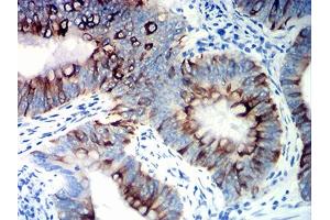 Immunohistochemical analysis of paraffin-embedded colon cancer tissues using KRT20 mouse mAb with DAB staining. (KRT20 antibody  (AA 1-150))