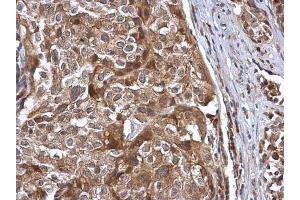 IHC-P Image Cullin 7 antibody [C2C3], C-term detects Cullin 7 protein at cytoplasm in human cervical carcinoma by immunohistochemical analysis. (Cullin 7 antibody  (C-Term))