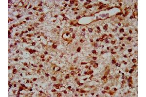 IHC image of ABIN7172127 diluted at 1:400 and staining in paraffin-embedded human glioma performed on a Leica BondTM system.