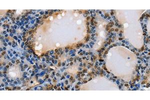 Immunohistochemistry of paraffin-embedded Human thyroid cancer using NFKBID Polyclonal Antibody at dilution of 1:40