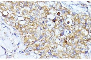 Immunohistochemistry of paraffin-embedded Human mammary cancer using EIF3L Polyclonal Antibody at dilution of 1:100 (40x lens).