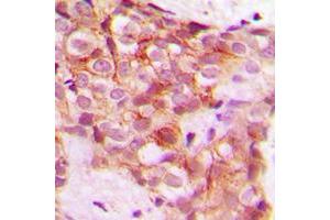 Immunohistochemical analysis of Collagen 5 alpha 1 staining in human breast cancer formalin fixed paraffin embedded tissue section. (COL5A1 antibody  (Center))