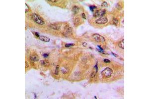 Immunohistochemical analysis of SMAD2 (pS467) staining in human lung cancer formalin fixed paraffin embedded tissue section. (SMAD2 antibody  (C-Term, pSer467))