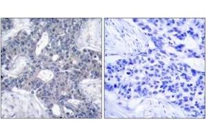Immunohistochemistry analysis of paraffin-embedded human breast carcinoma tissue, using ZAP-70 (Ab-493) Antibody. (ZAP70 antibody  (AA 460-509))