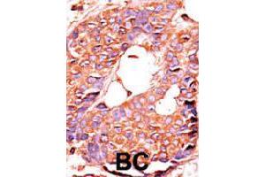 Formalin-fixed and paraffin-embedded human breast cancer tissue reacted with PPP6C polyclonal antibody  , which was peroxidase-conjugated to the secondary antibody, followed by AEC staining. (PPP6C antibody  (N-Term))